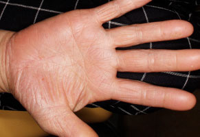 宮古島 高輪アイランドクリニック 掌蹠膿疱症の治療経過 2019年11月25日（6ヶ月後） 乳酸菌内服治療終了間際